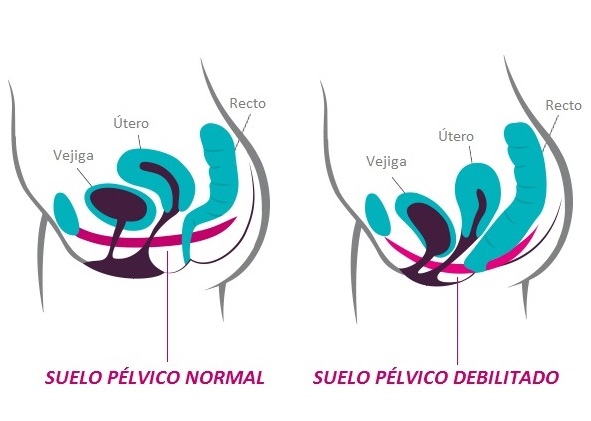 Suelo Pélvico